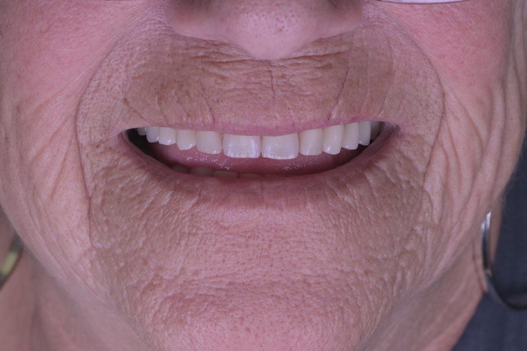 Federal-Dent — before after 1