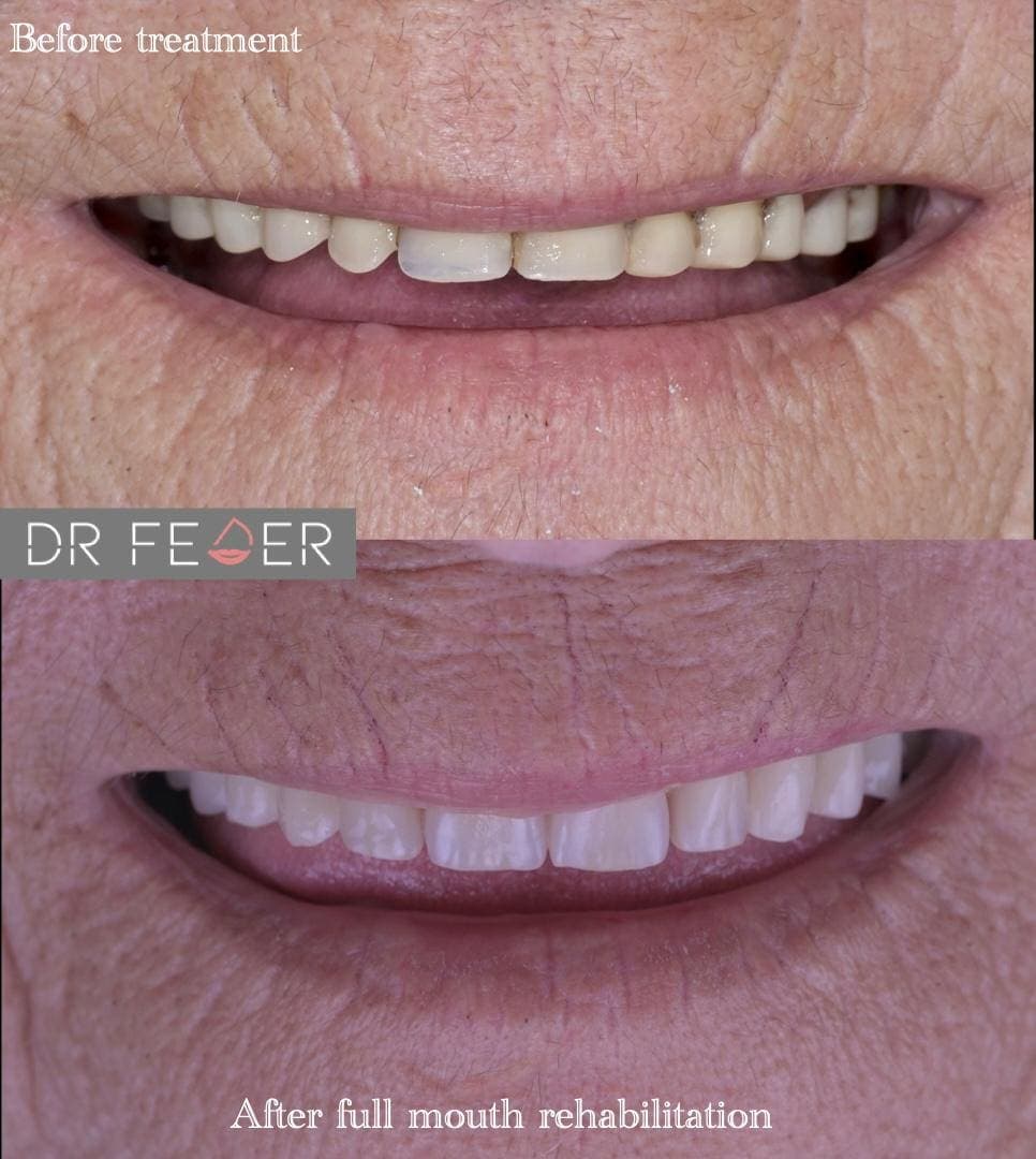 Full-Mouth Rehabilitation