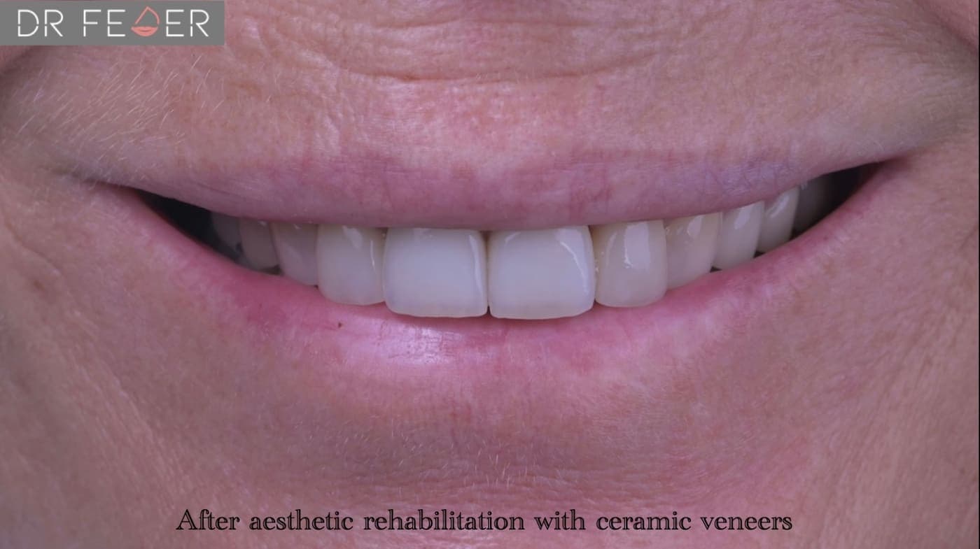 Ceramic Veneers